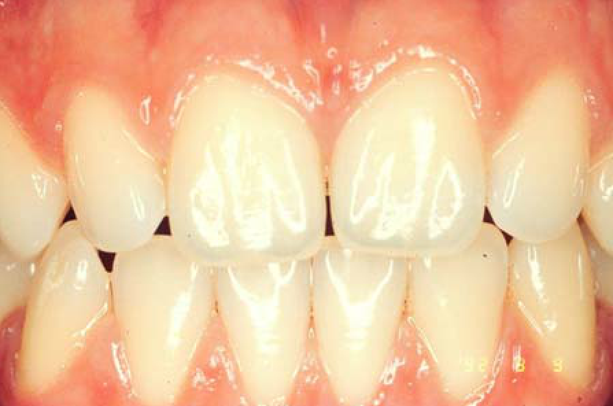 Ortognatodonzia centro-odontostomatologico-coppola-terapia-ortognatodonzia-006