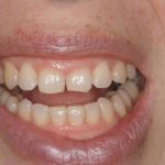 centro-odontostomatologico-coppola-dentista-gallarate-dentista-varese-terapia-allungamento-corona-001