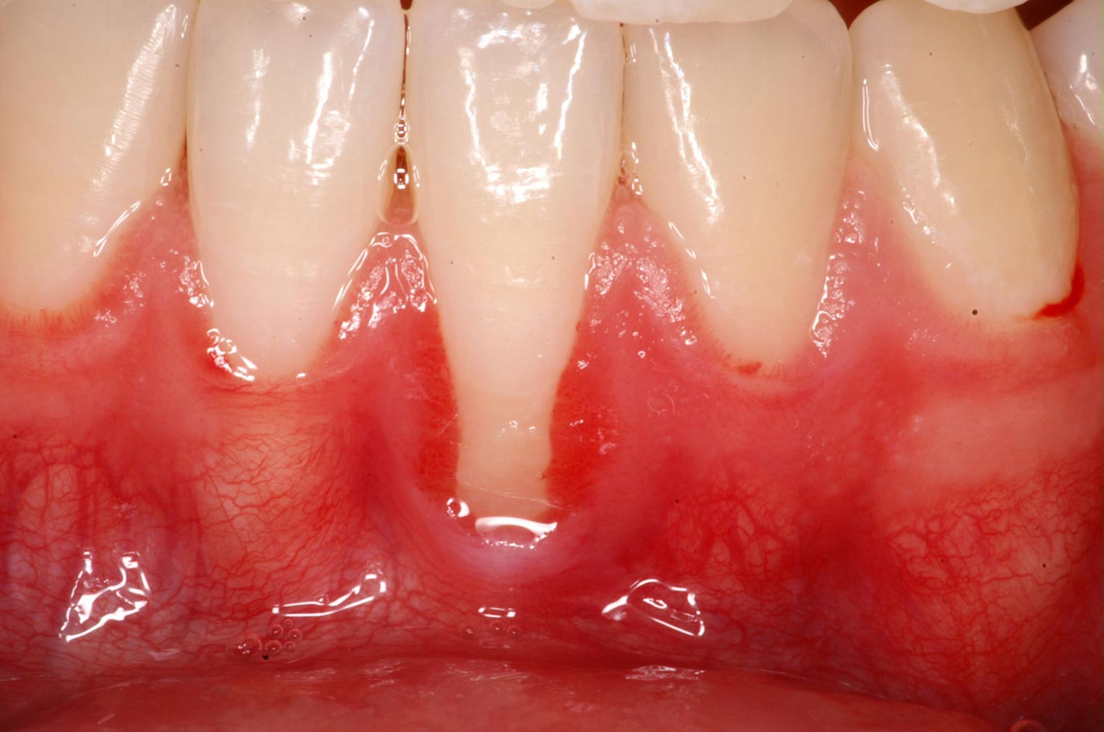 centro-odontostomatologico-coppola-dentista-gallarate-dentista-varese-terapia-parodontologia-maffei-pre
