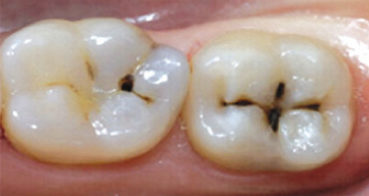 centro-odontostomatologico-coppola-terapia-conservativa-denti-001