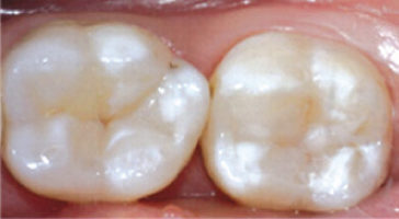 centro-odontostomatologico-coppola-terapia-conservativa-denti-002