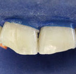 centro-odontostomatologico-coppola-terapia-conservativa-denti-003