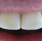 centro-odontostomatologico-coppola-terapia-conservativa-denti-004